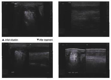 4 black and white picture before and after treatment