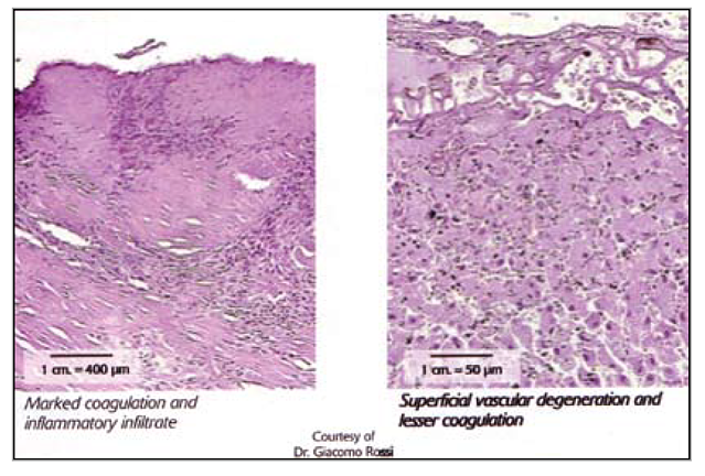 electro and photo coalgualtion