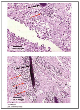foreign body reaction suture