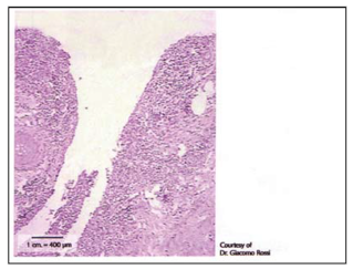 Traditional Surgical Incision After Day 1
