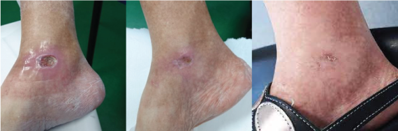 Leg Ulcer Before and After