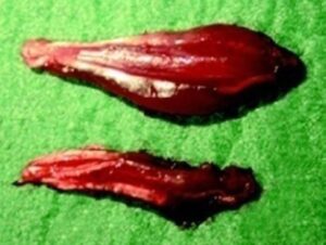 Muscular Trophism Recovery