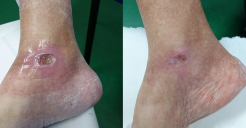 leg ulcer, pretreatment, 20 treatment