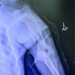 Figure 2.1 Left humerus fracture