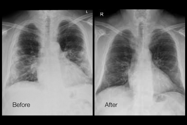 Before and After Comparison of Lungs Treated with MLS Laser Therapy for COVID-19