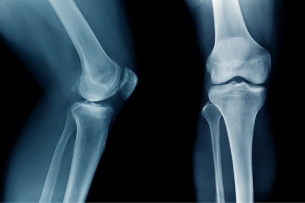 x-ray of the knee