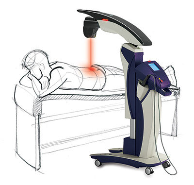 Illustration of MLS Laser Therapy treating patient's back