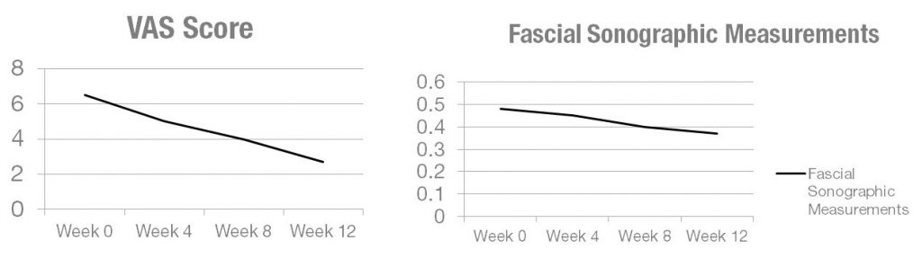 Affect of MLS Laser Therapy on Plantar Fasciitis | VAS Score | Fascial Sonographic Measurements