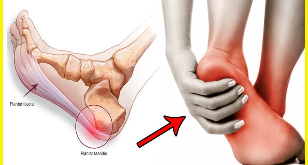 How Can Plantar Fasciitis be Treated 