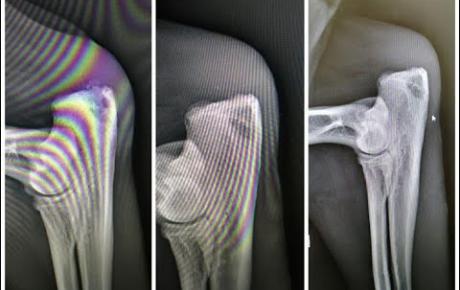 X-rays showing the bone healing progress